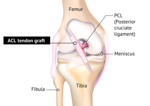 Should You Repair A Torn Acl? That's A Surprisingly Tricky Question 